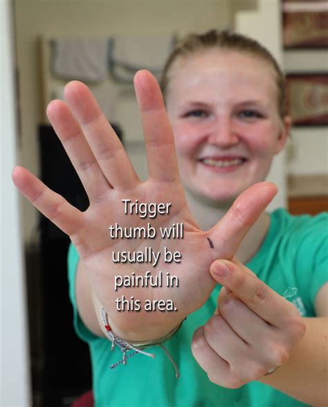 Trigger Finger or Trigger Thumb: Otherwise Known as Stenosing