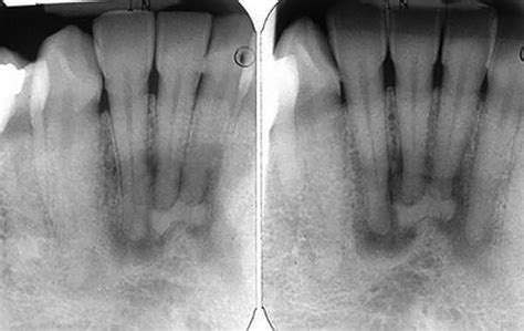 Differential Diagnosis Of Periapical Radiopacities And Radiolucencies