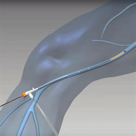 What To Expect From The Endovenous Laser Ablation Evla Procedure A