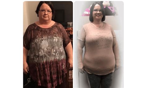 Weight Fluctuation After Gastric Sleeve Blog Dandk