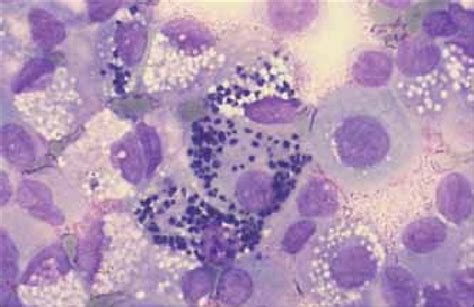 Pleural Fluid Macrophage Containing Many Intracellular Amastigotes