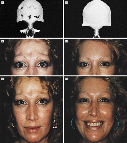 Reconstruction Of The Frontal Sinus And Frontofacial Skeleton With