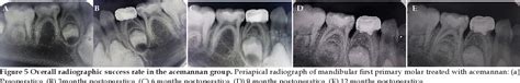 Efficacy Of Aloe Vera As A Pulpotomy Agent In Children Primary Teeth