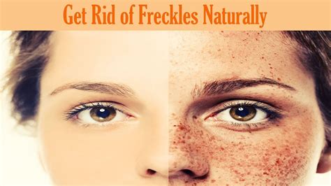 How To Get Rid Of Freckles Naturally And Fast Overnight Permanently Youtube