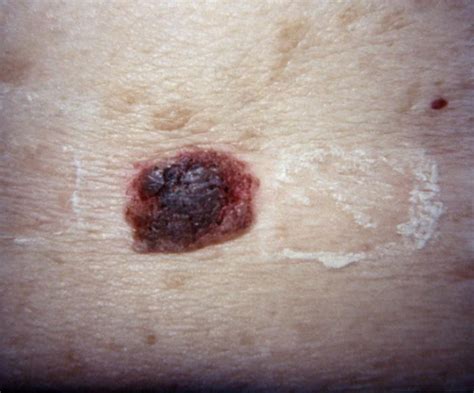 Seborrheic Keratosis Causes Symptoms Treatment Pictures Removal