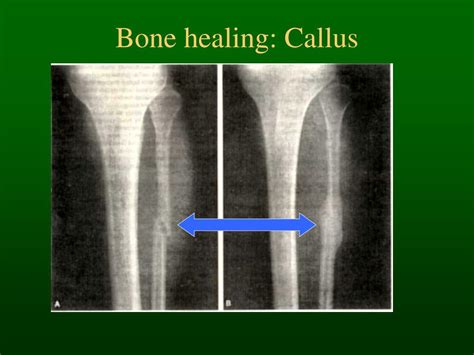 Ppt Bone Histology And Fracture Healing Powerpoint Presentation Free