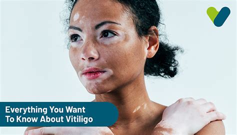 Vitiligo Symptoms Causes Treatments And Types Of Vitiligo Livlong