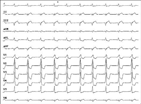 Figure 1 From Intermittent Atrioventricular Block In An Accessory