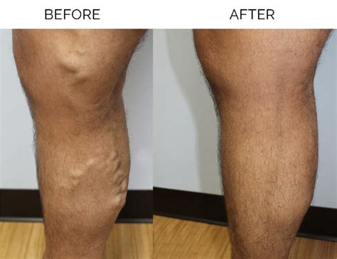 Addison Vein Clinic Specialists In Treatment Of Varicose Veins