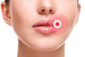 Bolle sulle labbra - le cause, le tipologie, i rimedi