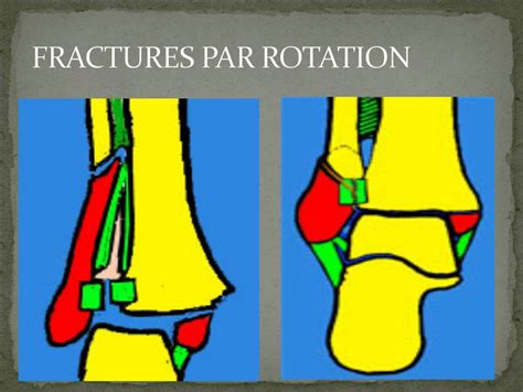 Traumatologie LES FRACTURES MALLEOLAIRES YouTube