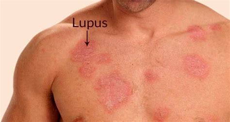 Most people with lupus experience some sort of skin involvement during the course of their disease. Combat Lupus Skin Rash On Body Naturally With These Potent ...