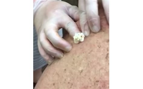 Large Zit In The Back New Pimple Popping Videos