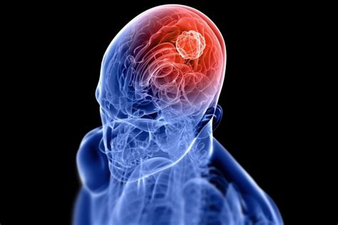 Meningioma Brain Tumor In Adults Causes And Risk Factors Diagnosis