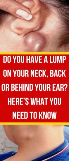Do Youve Got A Lump On Your Neck Back Or Behind Your Ear This