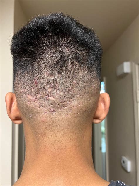 What Can I Do To Stop Forehead Acne Ive Been Dealing With This Ever