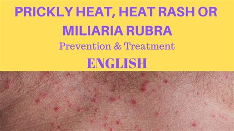Prickly Heat Heat Rash Or Miliaria Rubra Prevention And Treatment
