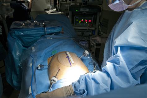 ¿qué Es Una Hernia Laparoscopiamd