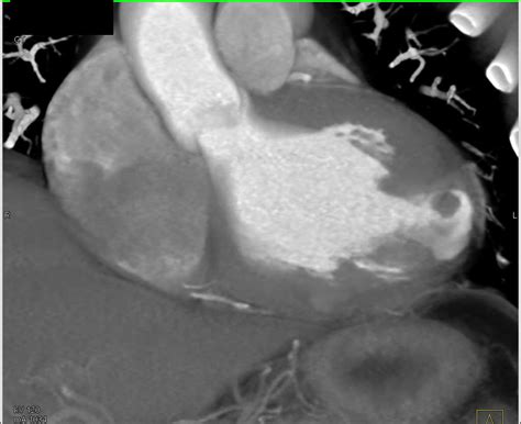 Foreign Material Near Left Ventricle Cardiac Case Studies Ctisus Ct