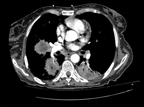 Lung Abscess Ct Wikidoc