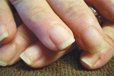 Nails That Tell Health Condition Nails Indicate Diseases