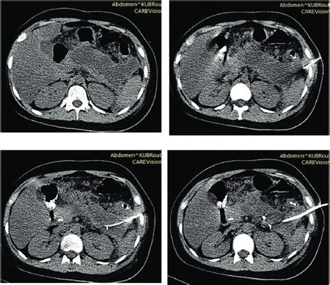 Large Pancreatic Collection Accessed Through Left Anterior Pararenal