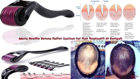 How Micro Needle Derma Roller System Work For Hair Regrowth In Bengali