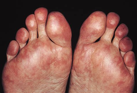 Delayed Appearance Of Livedo Reticularis In 3 Cases With A Cholesterol
