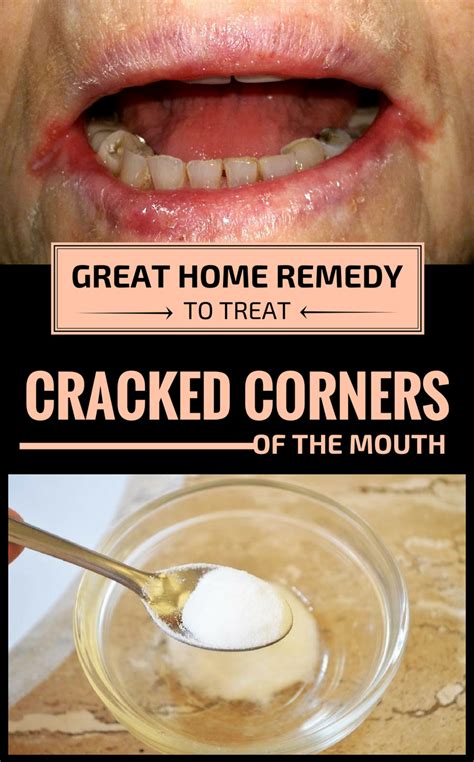 Pin On Home Remedy Tips