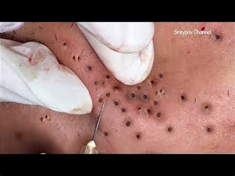 We apologize for any inconvenience. Giant Blackhead Removal - Pimple Popping Videos