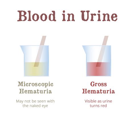 Hematuria Means Blood In Urine Gaytri Gandotra Md