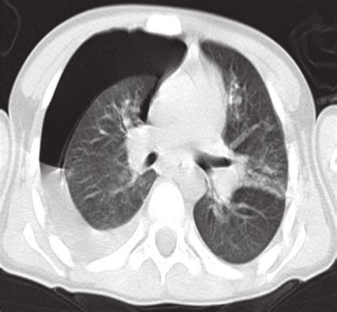 Thoracal Ct Image Showing Pleural Effusion And Pneumothorax Anterior