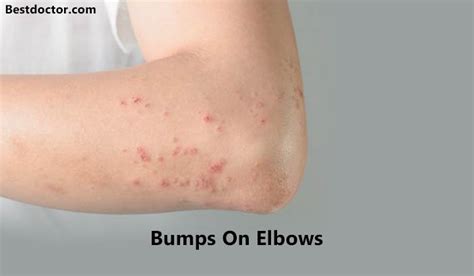 Raised Itchy Bumps On Elbows