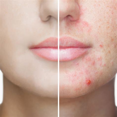 What Type Of Facial Is Best For Acne And Acne Scars