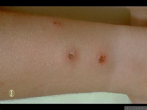 Bacterial Skin Infections Pptx دسلام التميمي Muhadharaty