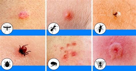12 Common Insect Bites And How To Spot Each One