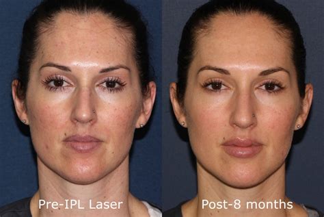 A Laser Skin Rejuvenation Procedure You Can Get On Your Lunch Break