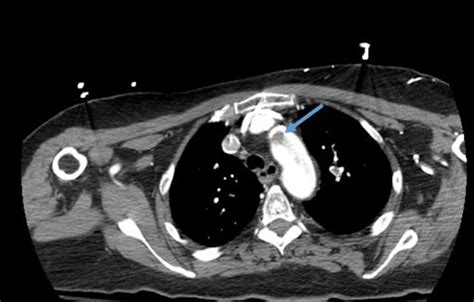 Cureus Aortic Thrombus Extending To Left Subclavian In A Patient With
