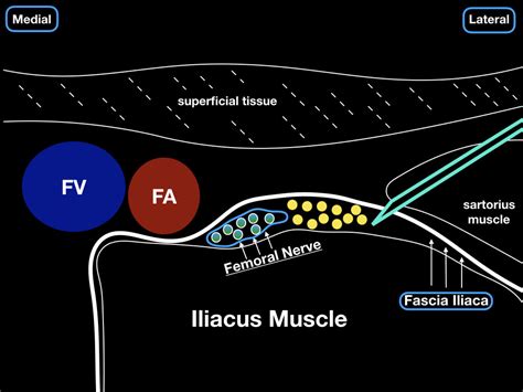 Femora Nerve Block — Highland Em Ultrasound Fueled Pain Management