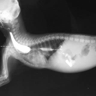 Canine megaesophagus is caused when a dog's esophagus muscles collapse in certain sections. (PDF) Megaesophagus caused by an aberrant right subclavian ...