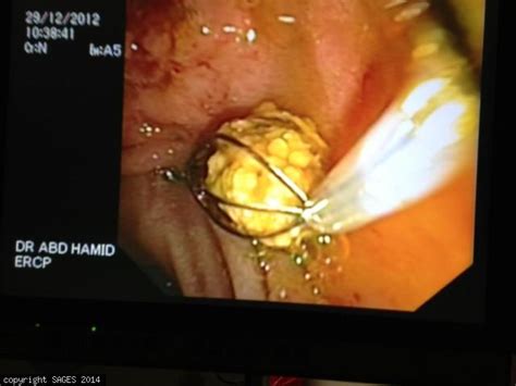 Common Bile Duct Stone Removed With A Dormia Basket Sages Image Library