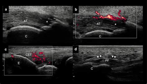 A B Dorsal Scan Of The Achilles Tendon A B Longitudinal View Active