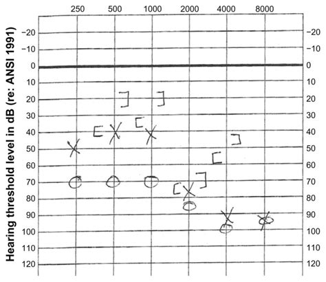 Audiogram Of The Patient Demonstrating Bilateral Mixed Hearing Loss