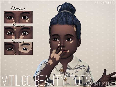 Peachtreees Vitiligo Beauty Skin Overlay Toddlers N4