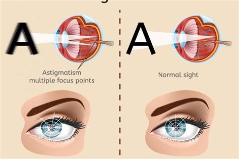 Frequently Asked Questions About Diplopia Or Double Vision Facty Health