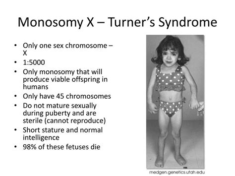 Ppt Down Syndrome Trisomy 21 Powerpoint Presentation Free Download Id 2170957