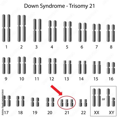 Karyotype Of Down Syndrome Stock Illustration Adobe Stock
