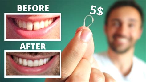 How Much To Fix Teeth Gap New