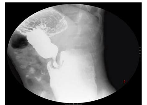 Figure From Intraluminal Diverticular Duodenal Duplication With Recurrent Abdominal Pain A