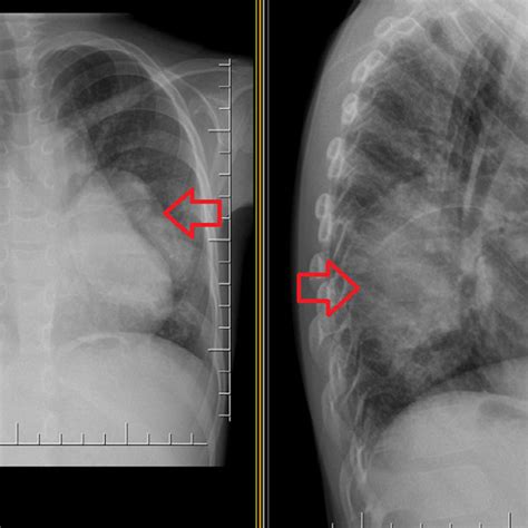 Follow Up Chest X Ray Done Shows Marked Enlargement Of The Left Hilar